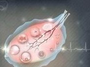 在山西卵泡黄素化如何治疗？